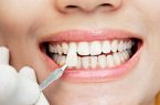 ونیر یا لومینیرز دندان کدام برای فرم دهی به دندان بهتر است؟