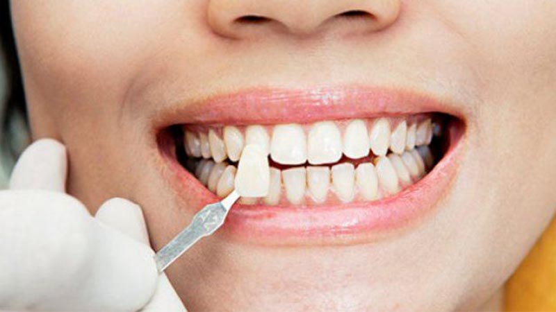 ونیر یا لومینیرز دندان کدام برای فرم دهی به دندان بهتر است؟